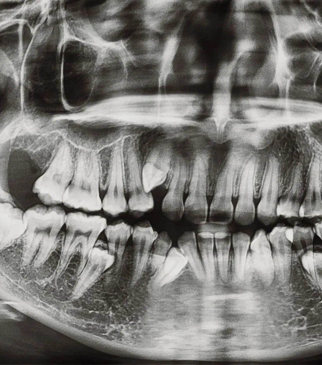 X-ray of impacted wisdom teeth